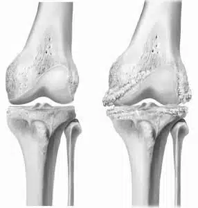 Healthy knee vs. arthritic knee
