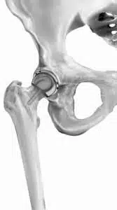 Birmingham hip resurfacing